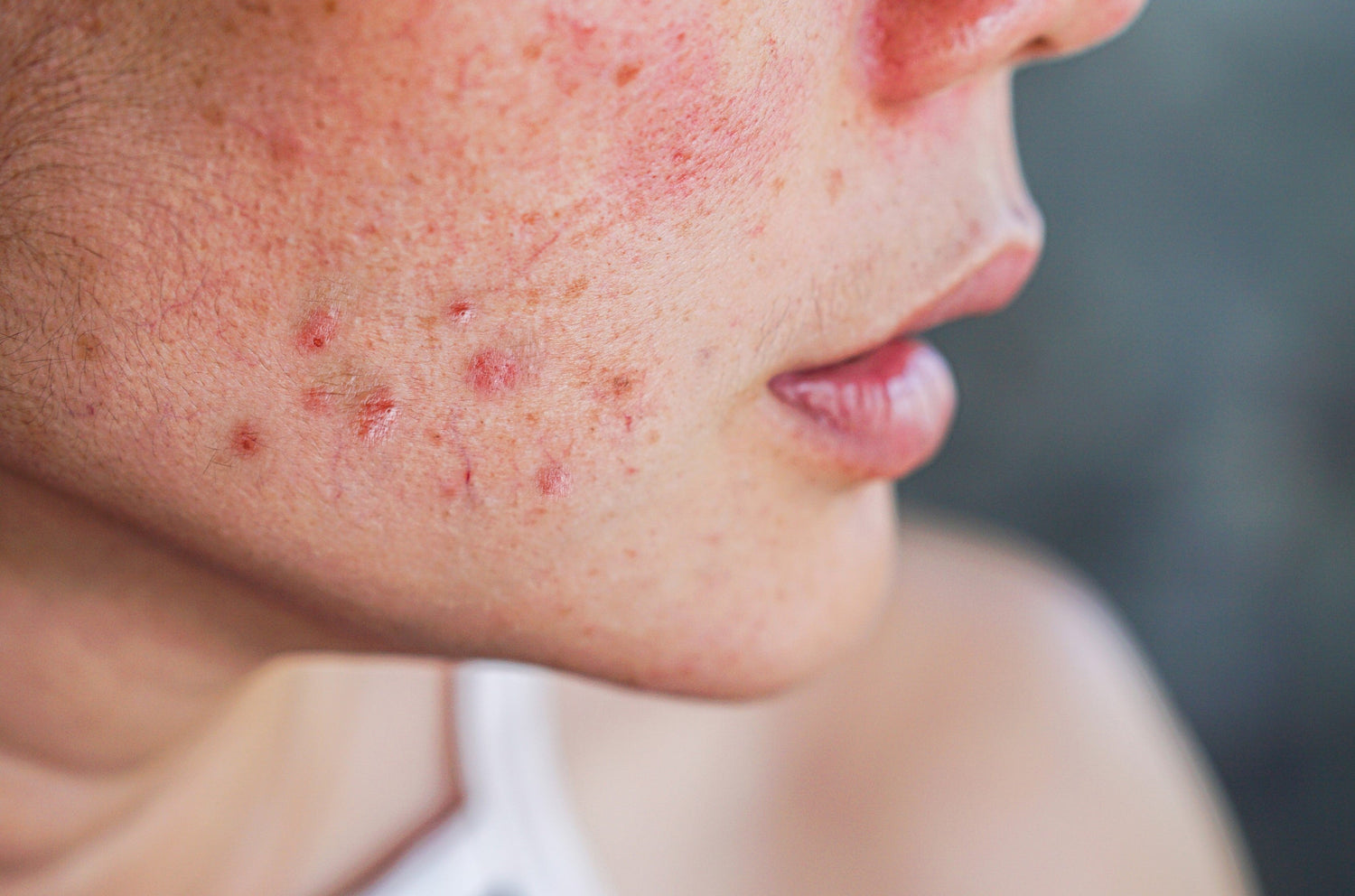 Acne PCOS causes and solutions